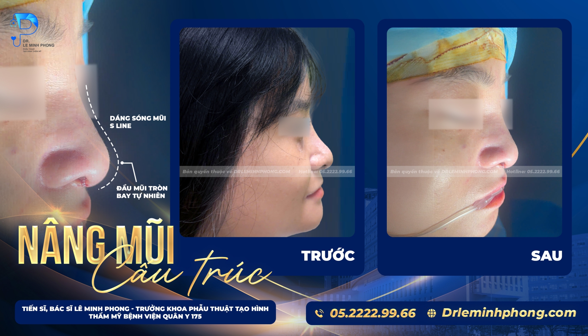 Nâng mũi cấu trúc L-Line - Nâng tầm thần thái gương mặt