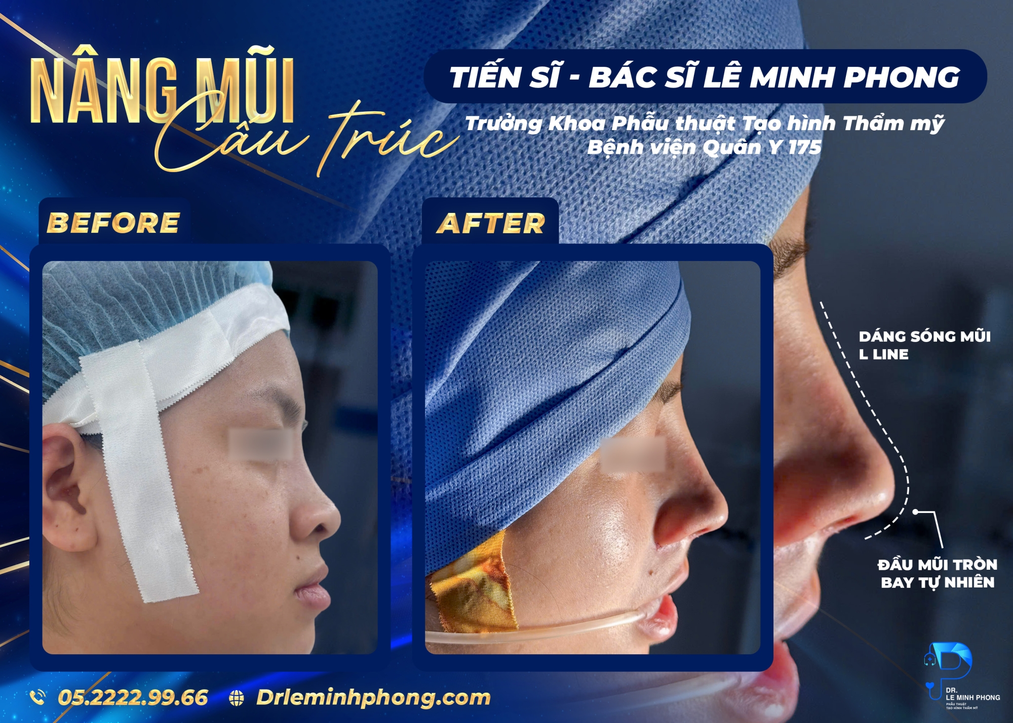 Nâng mũi cấu trúc thực hiện bởi TS.BS Lê Minh Phong