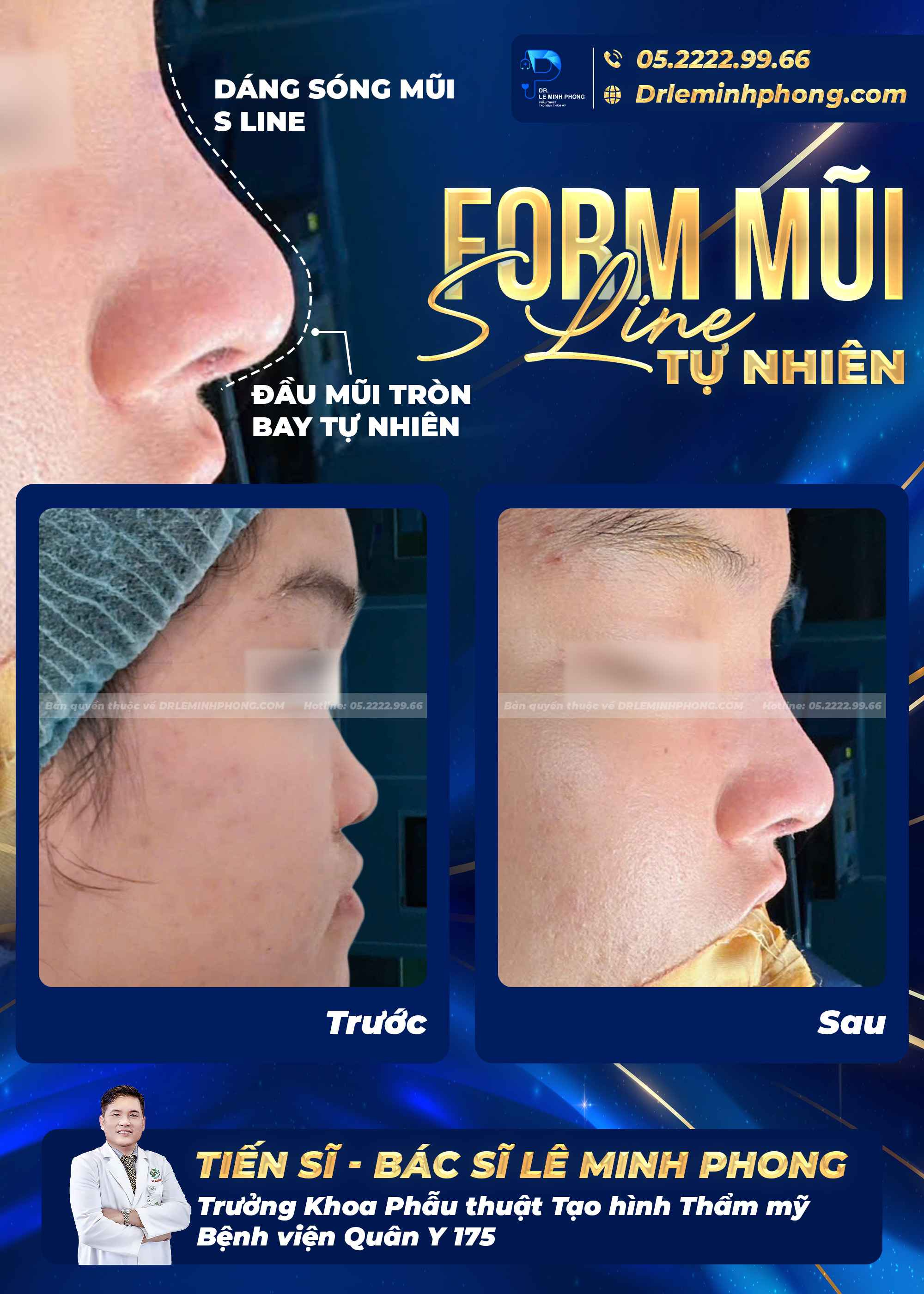 Nâng mũi cấu trúc S-Line – Dáng mũi bay thanh thoát, đầu mũi tròn tự nhiên hài hòa gương mặt