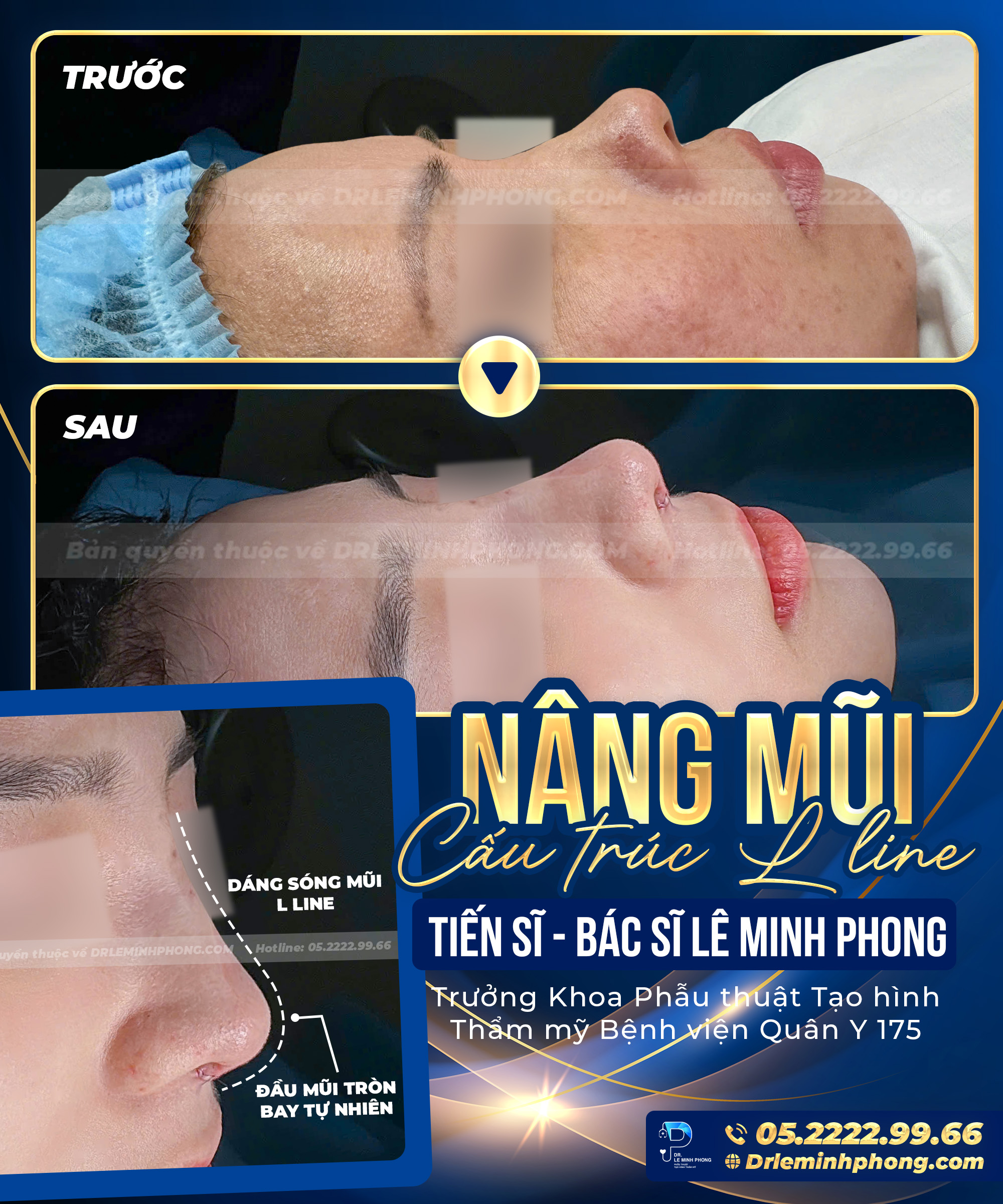 Nâng mũi cấu trúc L-Line – dáng mũi hài hòa theo tỷ lệ gương mặt