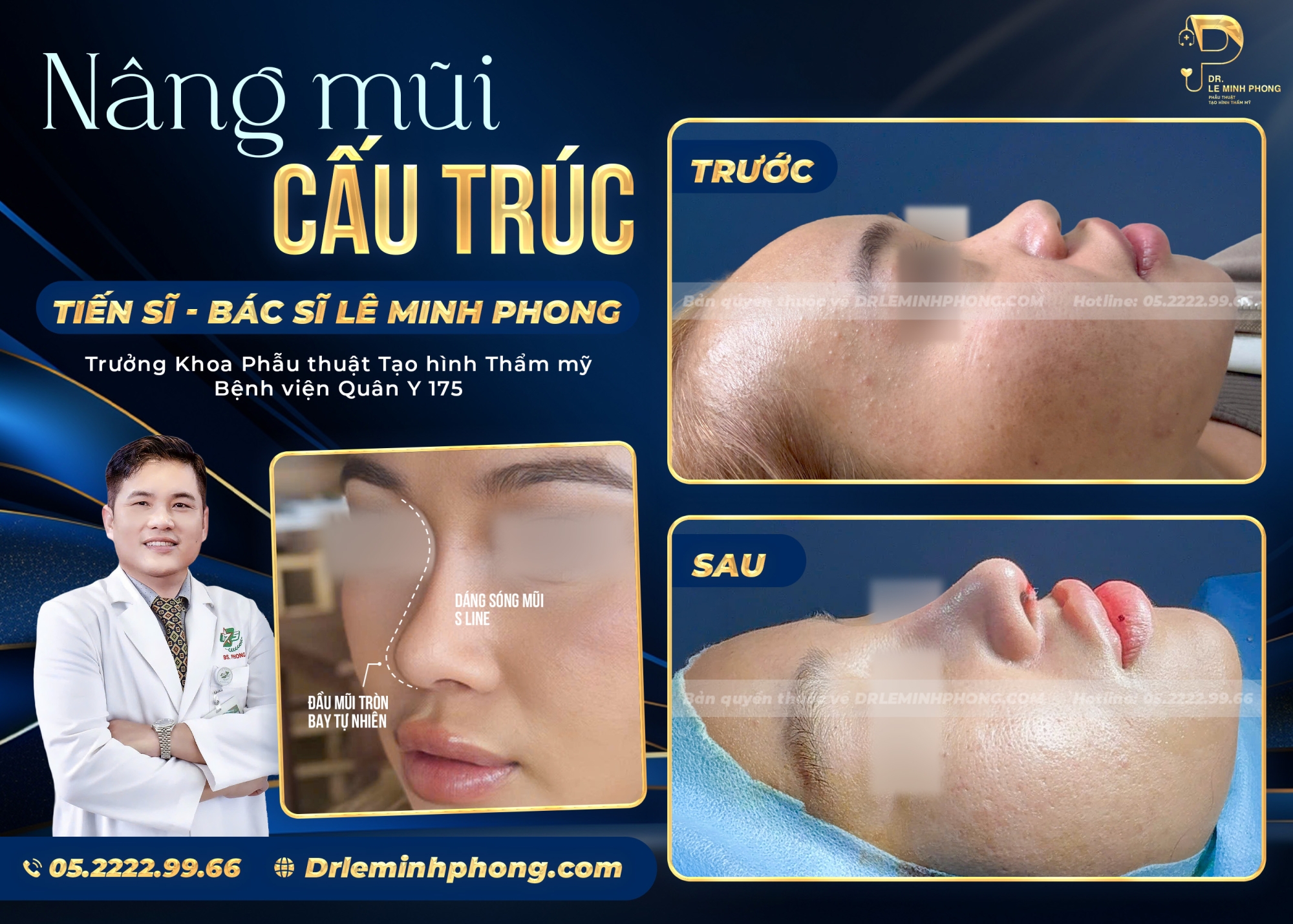 Feedback Nâng Mũi – Hành Trình Thay Đổi Diện Mạo Cùng TS.BS Lê Minh Phong