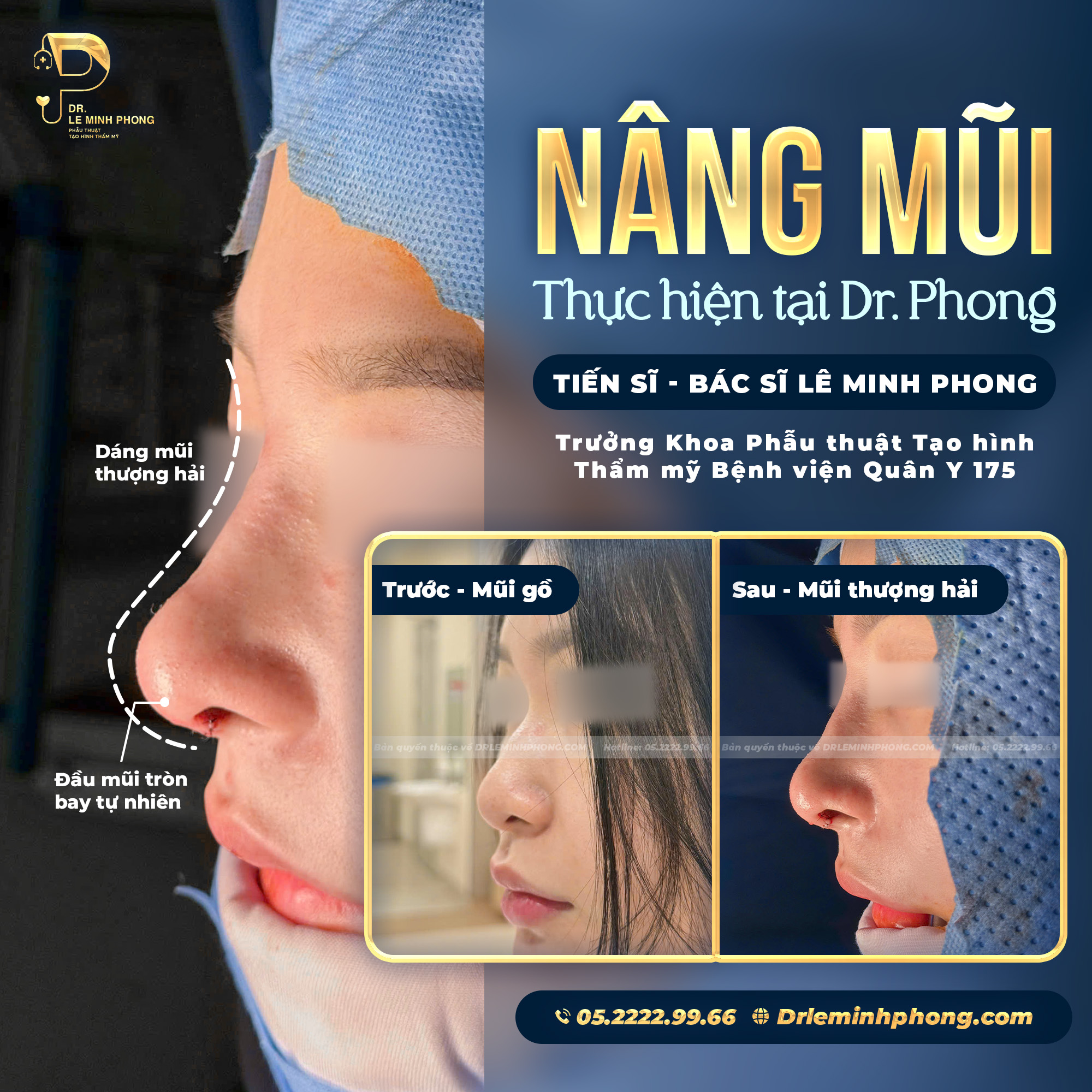 Nâng mũi dáng Thượng Hải – thanh thoát, mềm mại và có điểm nhấn . Dáng mũi Thượng Hải thường hướng đến đường nét cao vừa phải, sống mũi thanh thoát, đầu mũi gọn và có độ bay nhẹ.
