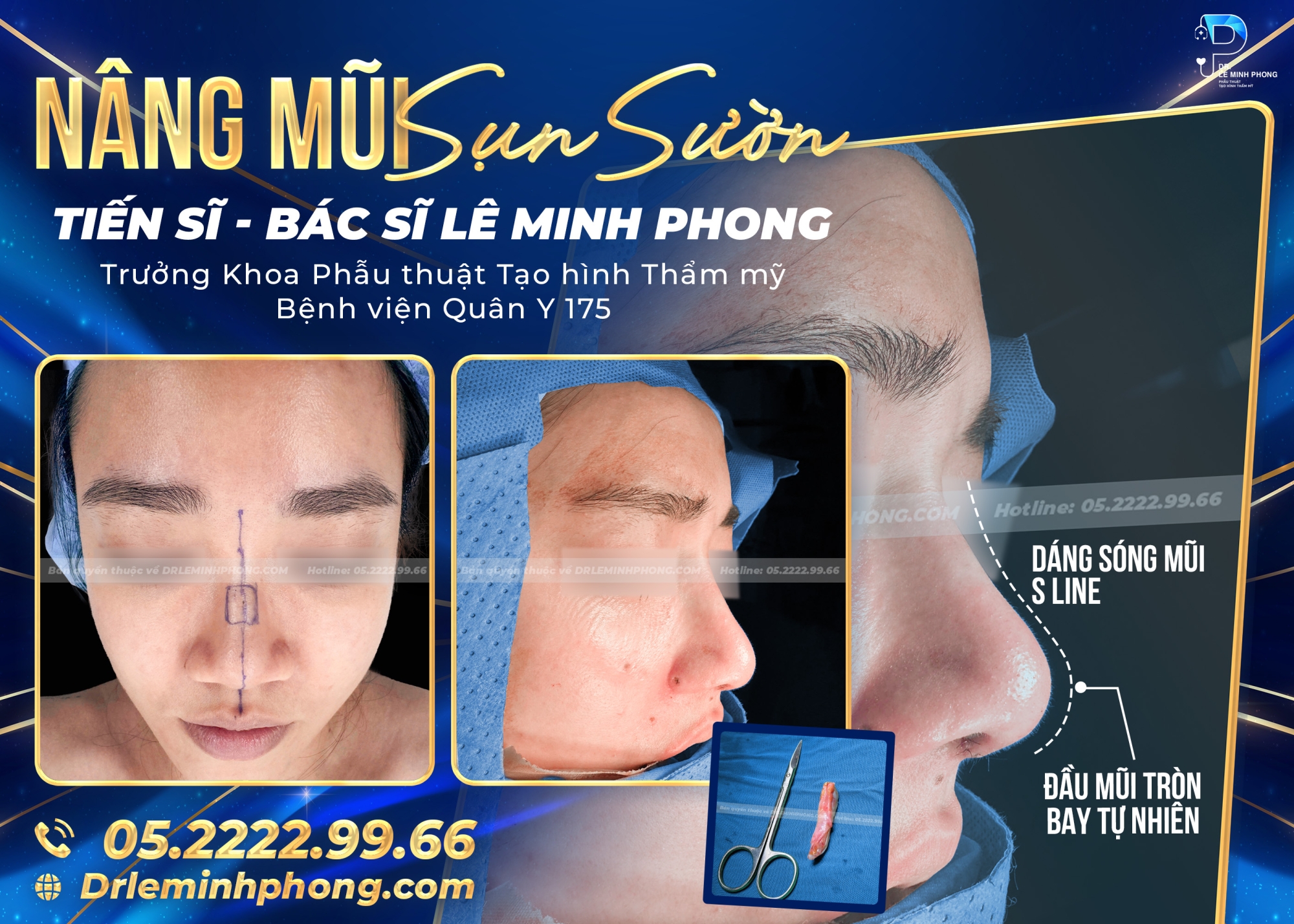 Nâng mũi sụn sườn thực hiện bởi TS.BS Lê Minh Phong 