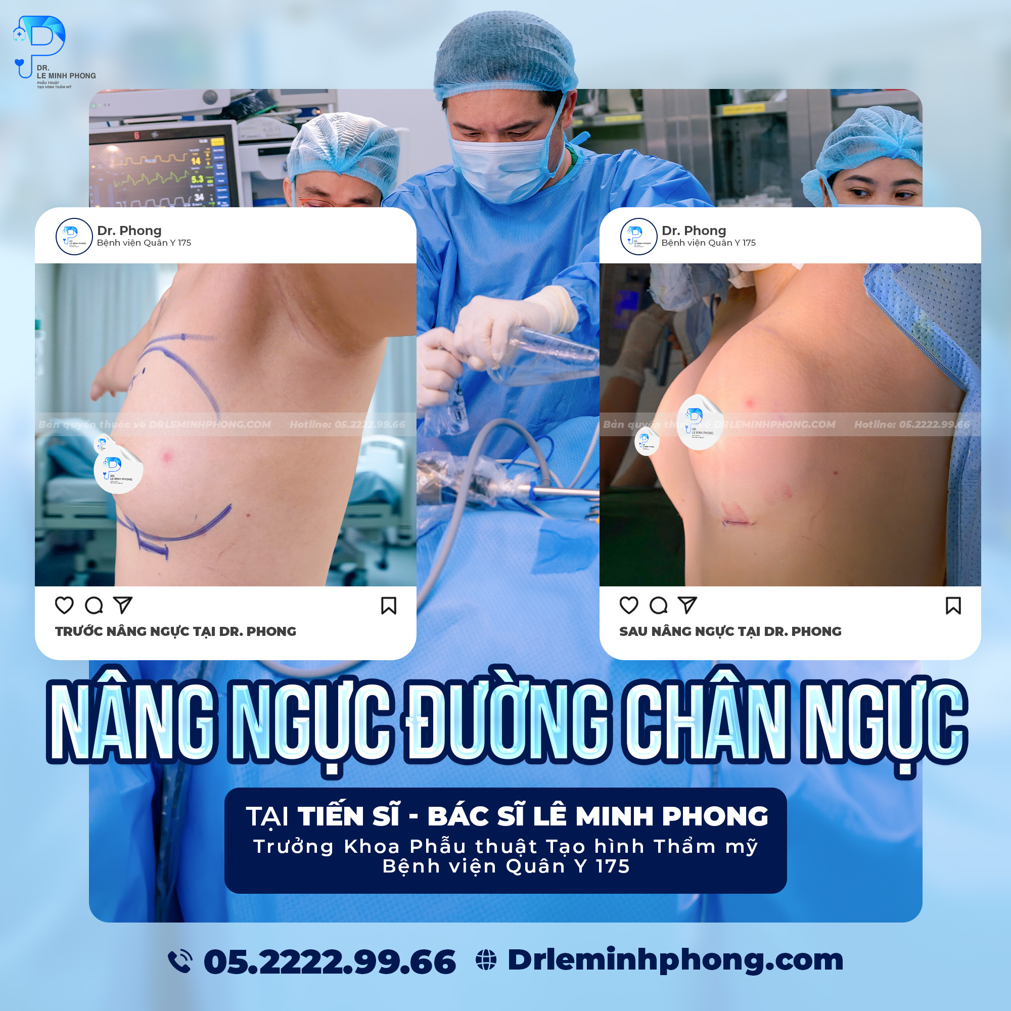  Nâng ngực đường chân ngực – Hình ảnh trước và sau phẫu thuật thực tế tại TS.BS Lê Minh Phong – BV Quân Y 175