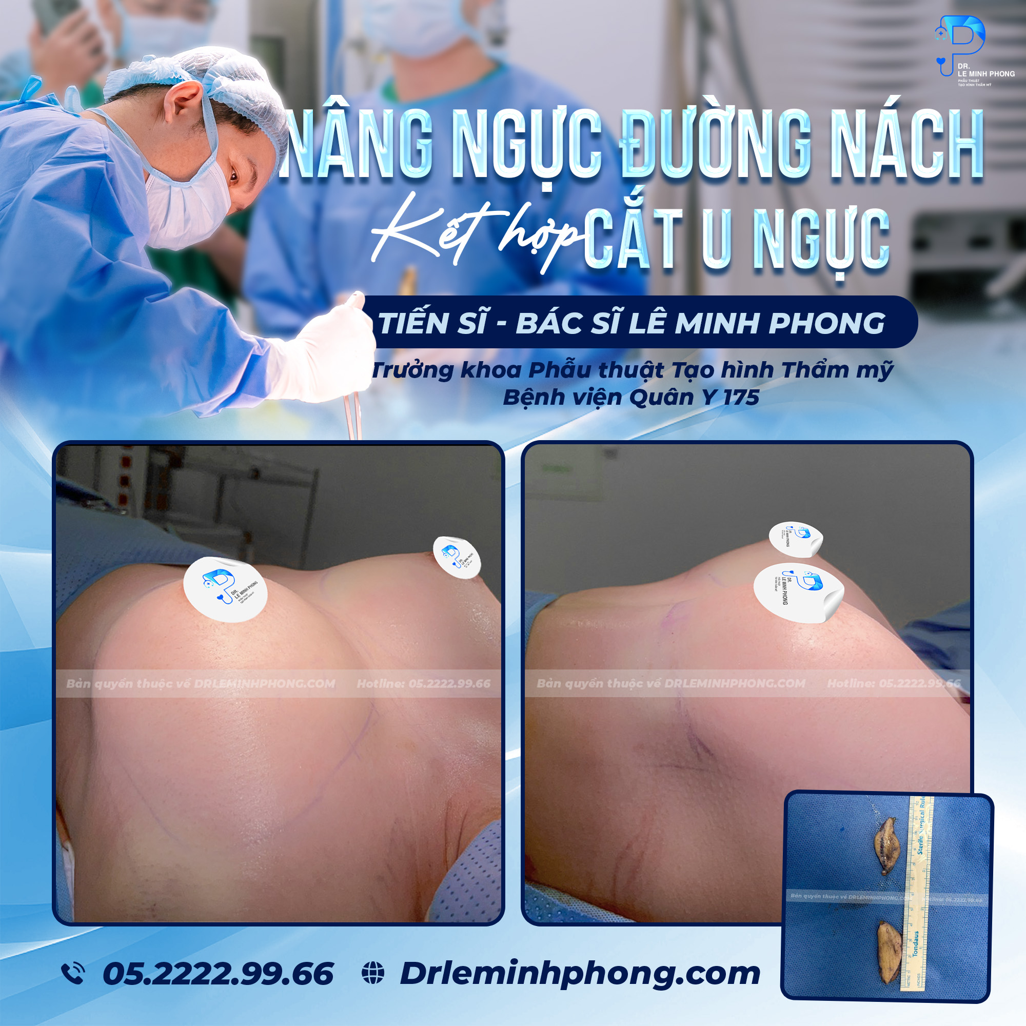 Nâng ngực đường nách kết hợp cắt khối u ngực cho khách hàng