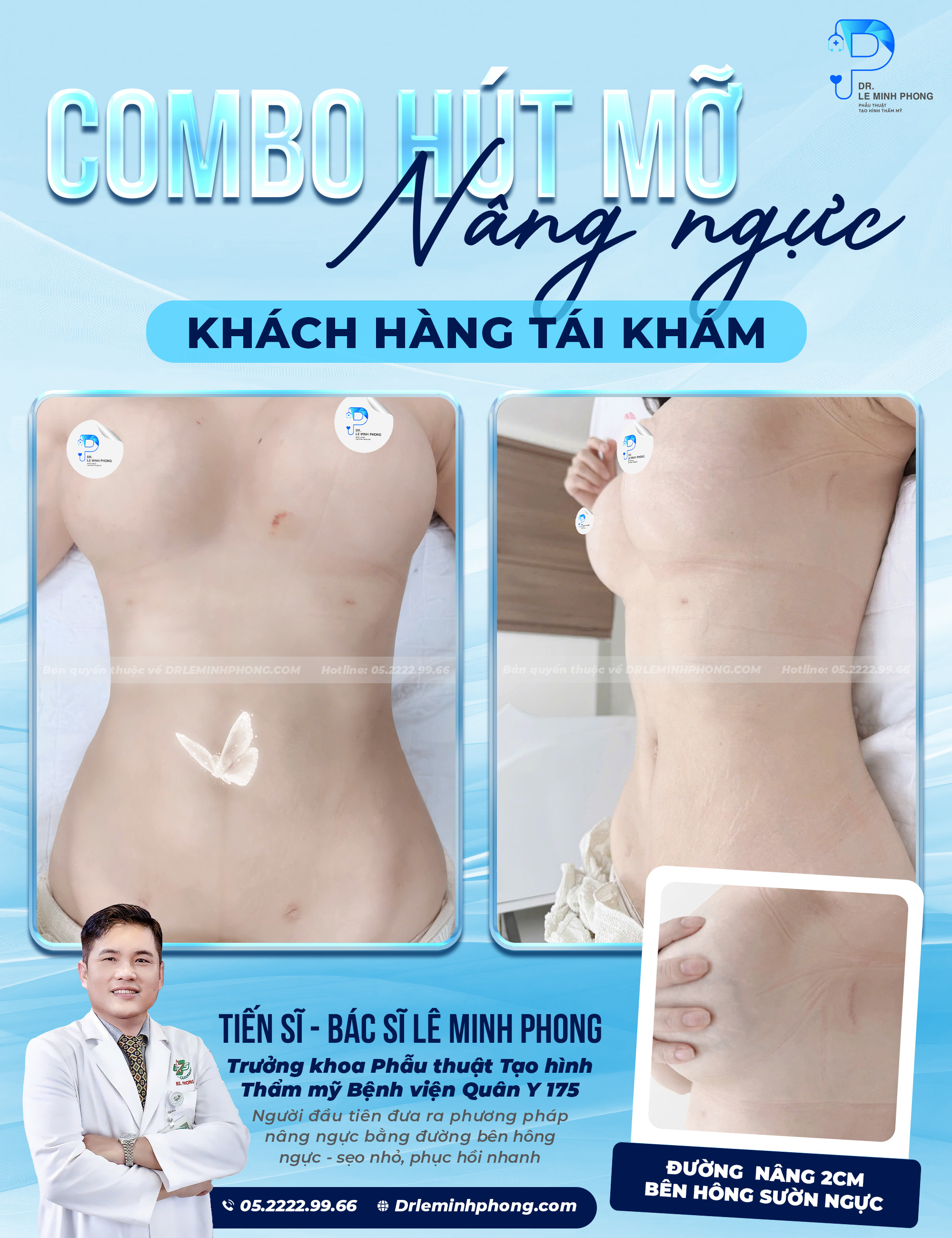 FB Combo hút mỡ bụng, nâng ngực sau 3 tháng 