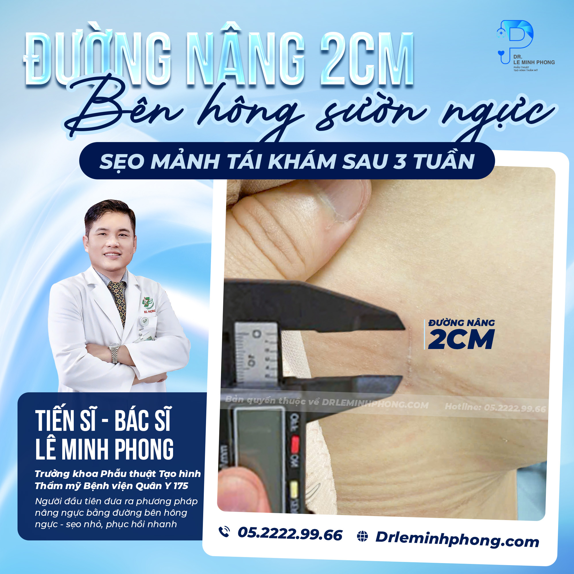 Nâng Ngực Đường Bên Hông 2cm – Kết Quả Sau 3 Tuần Hồi Phục