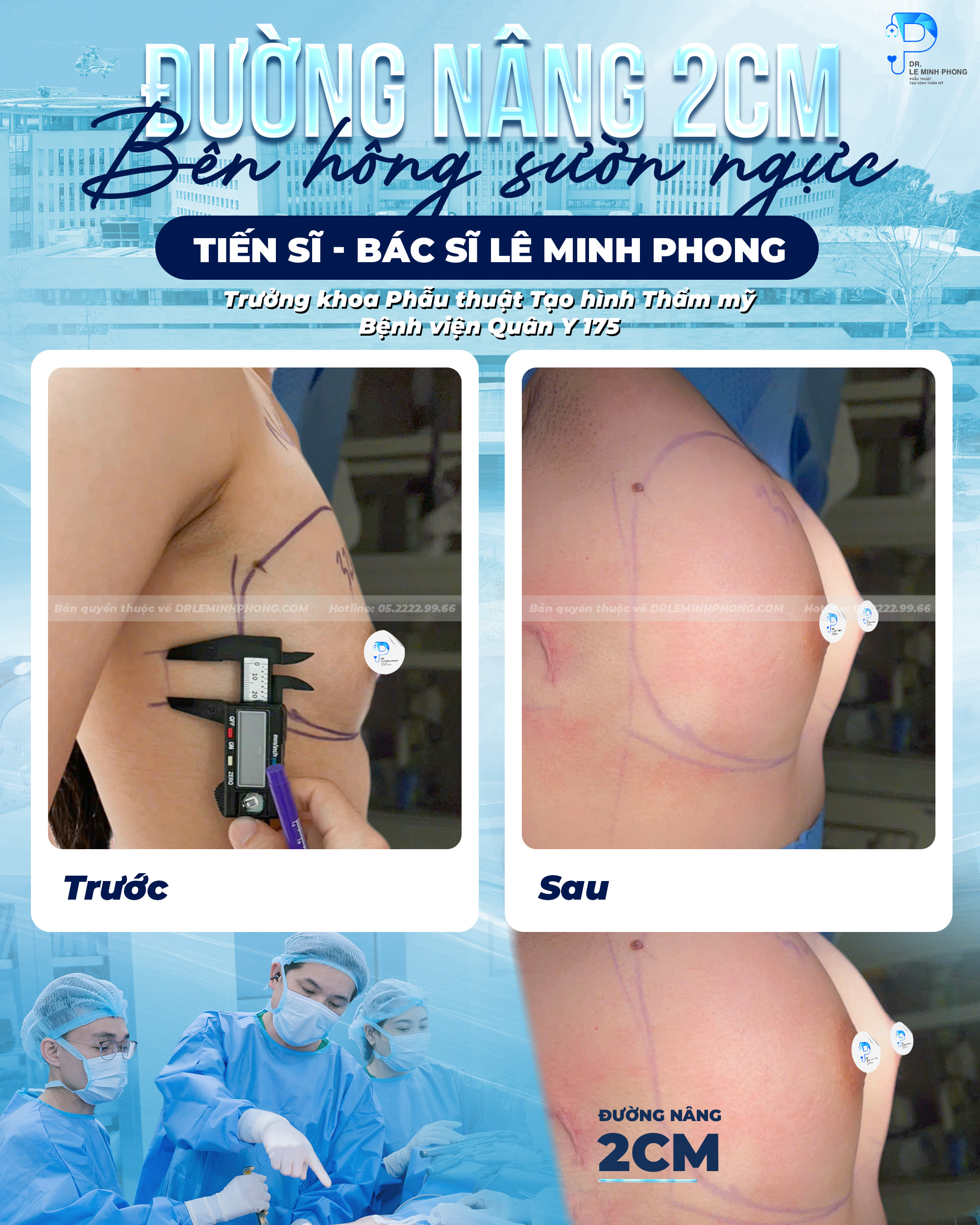 Ngực Nhỏ – Thay Đổi Tự Tin Với Đường Nâng Bên Hông Sườn Chỉ 2cm 