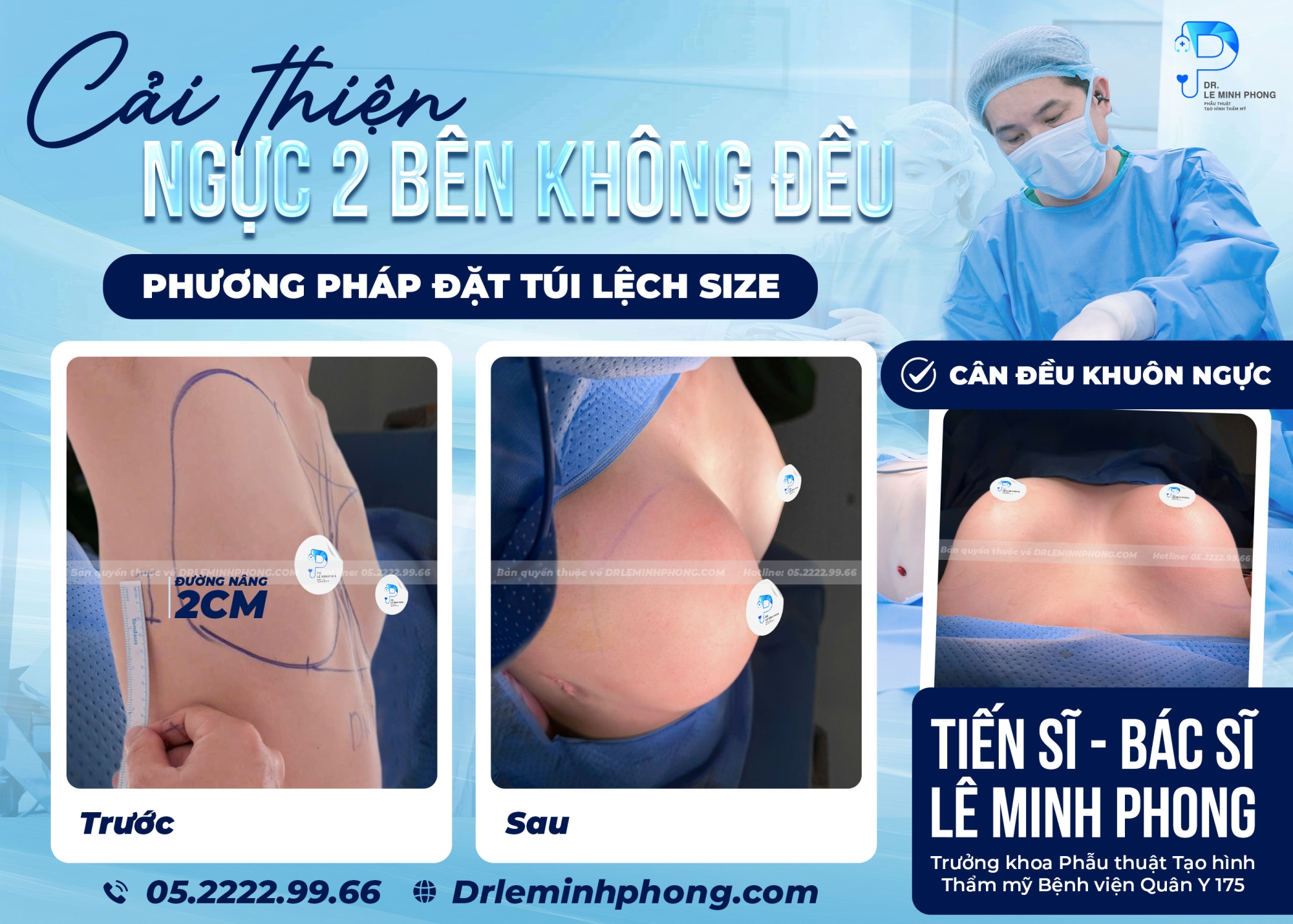 Cải Thiện Tình Trạng Ngực Hai Bên Không Đều Bằng Kỹ Thuật Đặt Túi Lệch Size