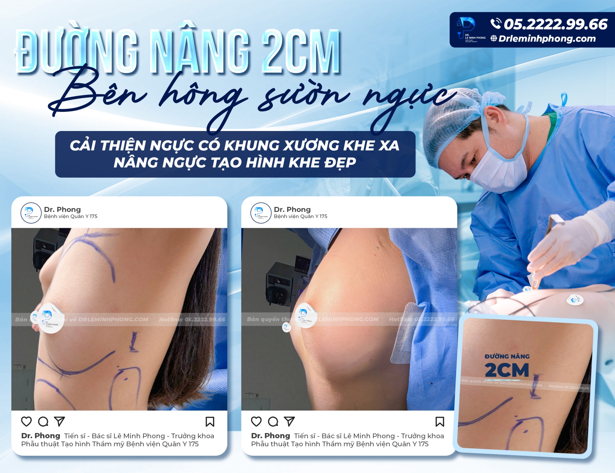 Đường Nâng Bên Hông Sườn Chỉ 2cm – Cải Thiện Tình Trạng Khe Ngực Xa, Kiến Tạo Vòng 1 Cân Đối