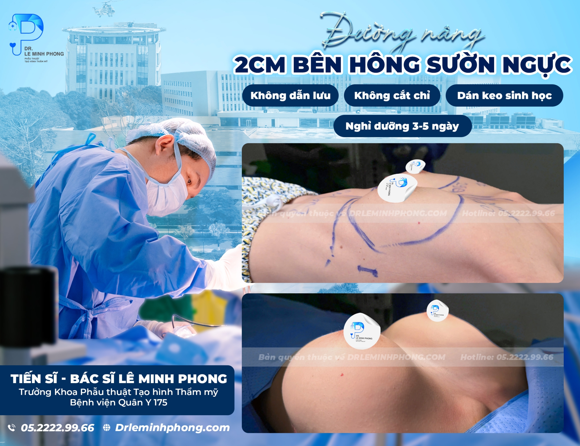 Ngực cơ địa mô ít, túi độ nhô cao đường nâng bên hông sườn ngực dấu sẹo mảnh nhỏ 2cm