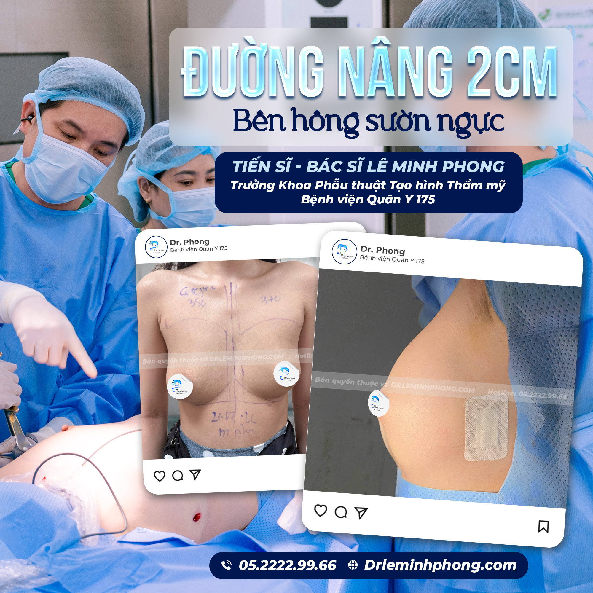 Đường nâng 2cm bên hông sườn ngực