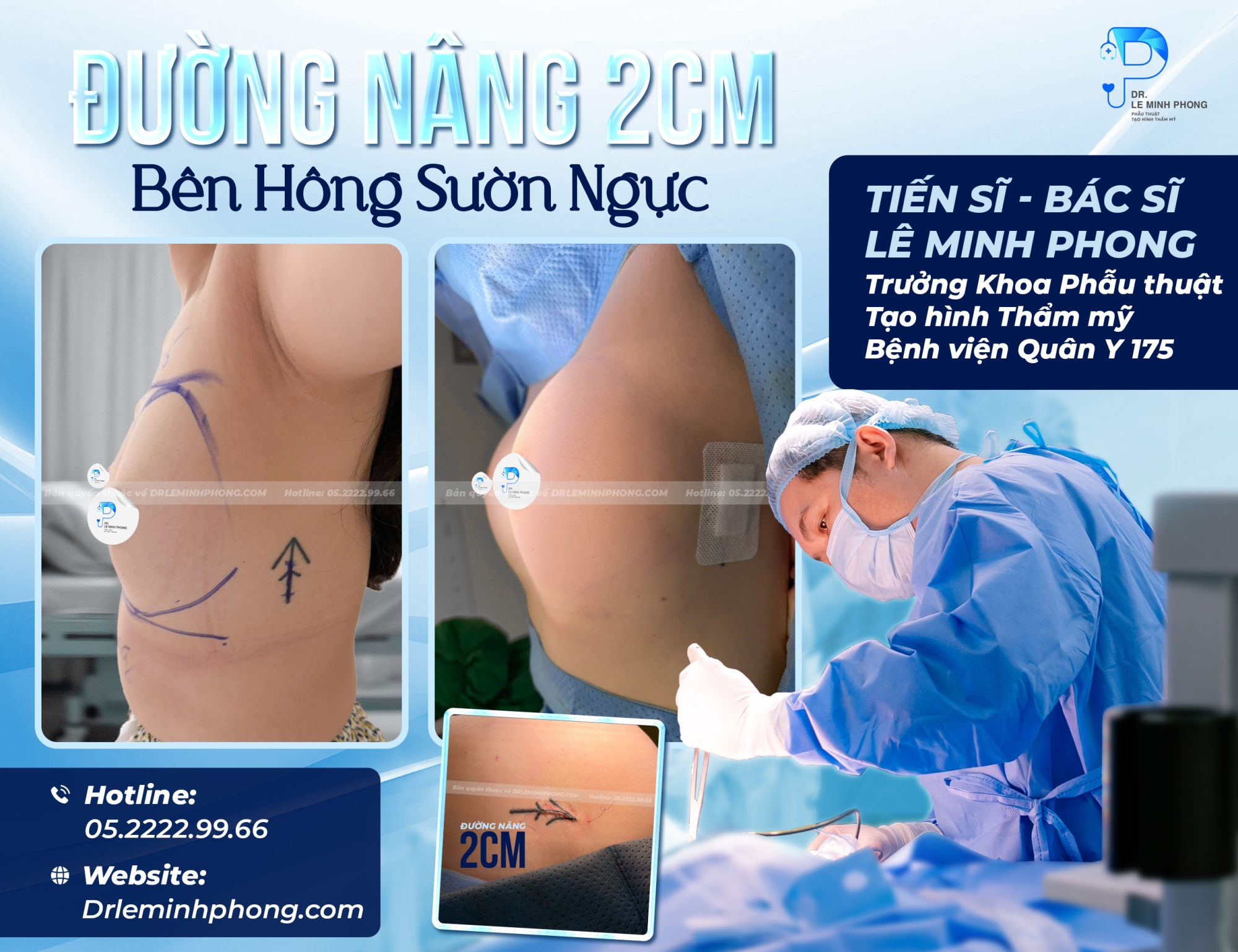 Đường nâng 2cm bên hông sườn ngực 1