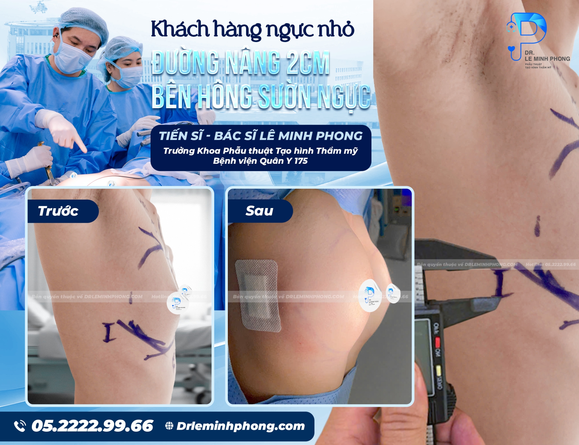 Khách hàng ngực nhỏ - Đường nâng 2cm