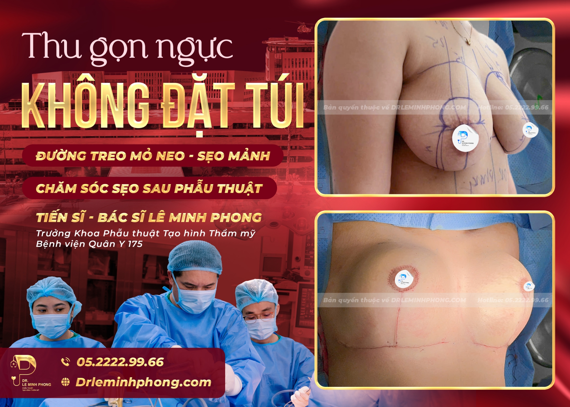 Phẫu thuật thu gọn ngực đường mỏ neo không đặt túi