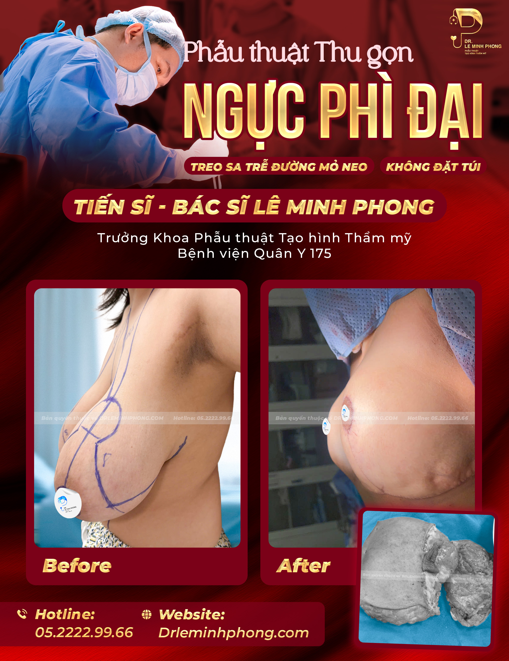 Phẫu Thuật Thu Gọn Ngực Phì Đại An Toàn, Thẩm Mỹ | Dr. Phong