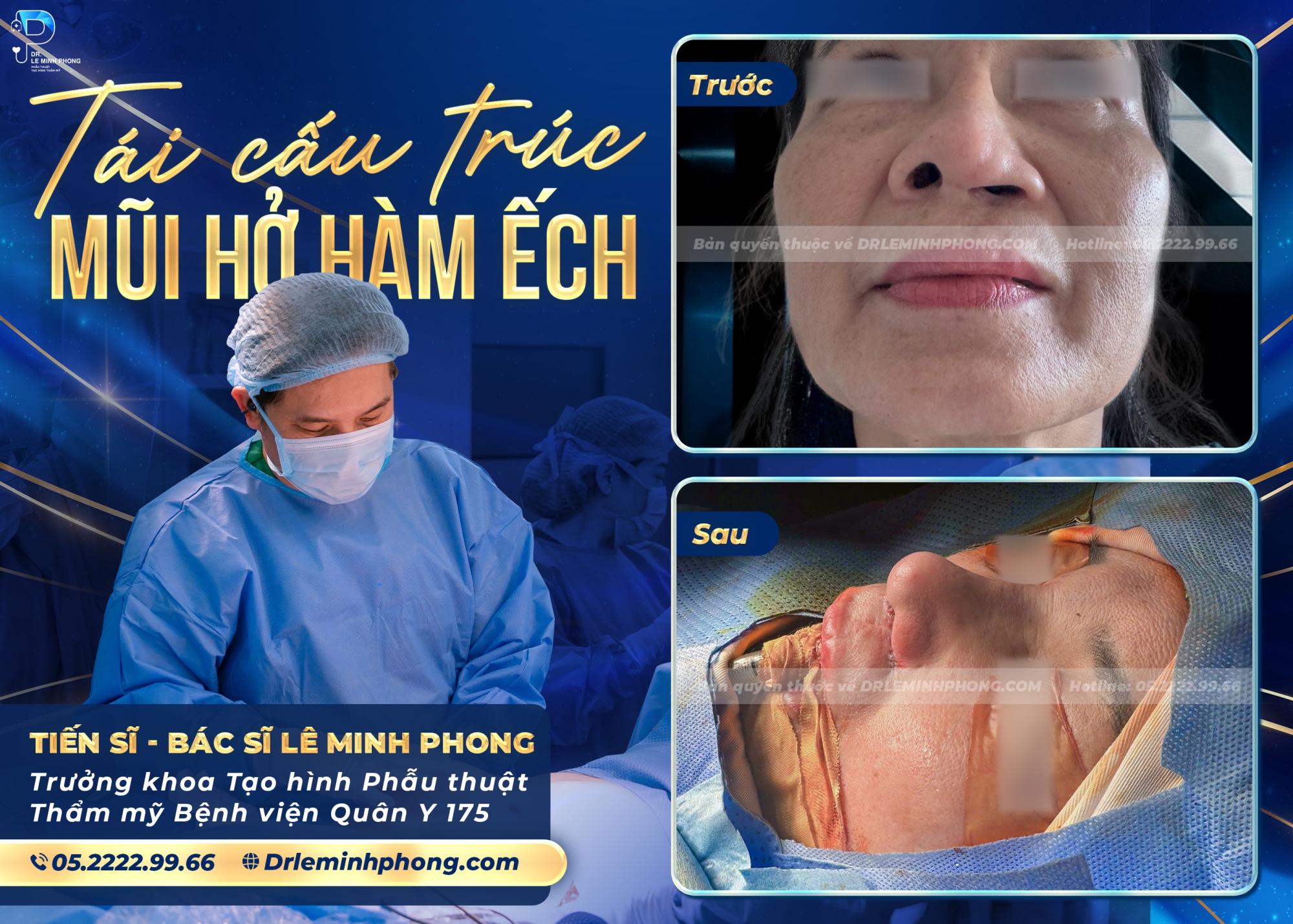 Tái cấu trúc mũi hở hàm ếch - Hành trình cải thiện chức năng và thẩm mỹ