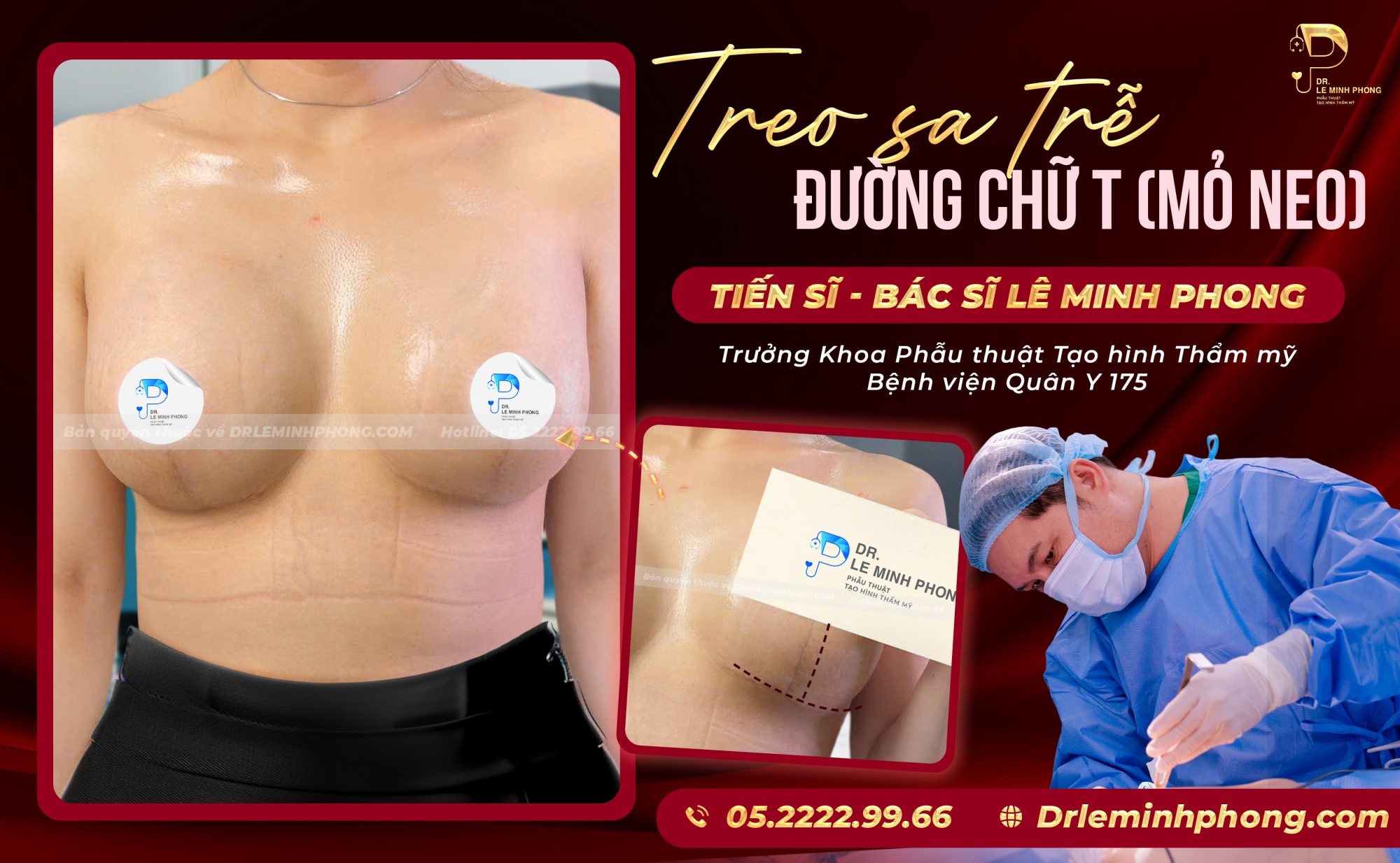  Treo sa trễ đường chữ T mỏ neo cho khách hàng sau1 năm sẹo đã hồi phục