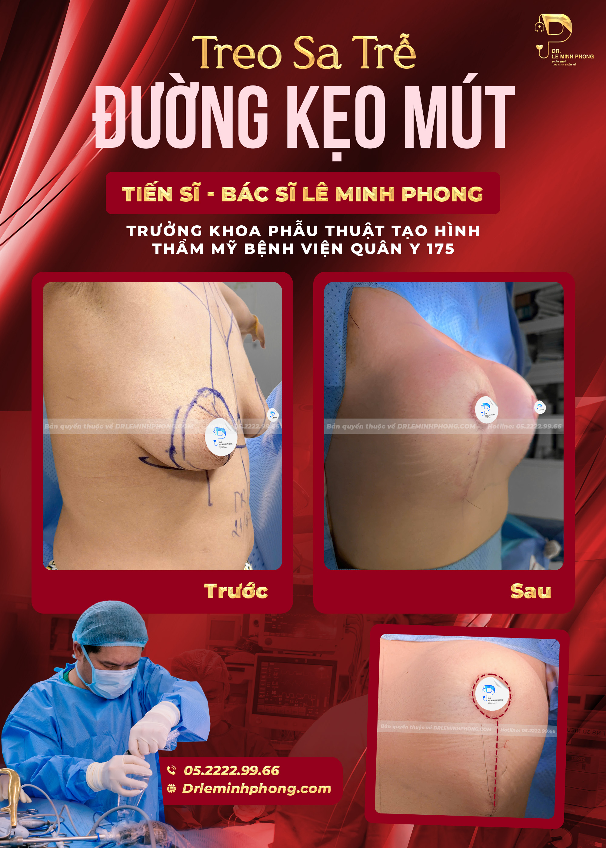 Treo sa trễ đường kẹo mút