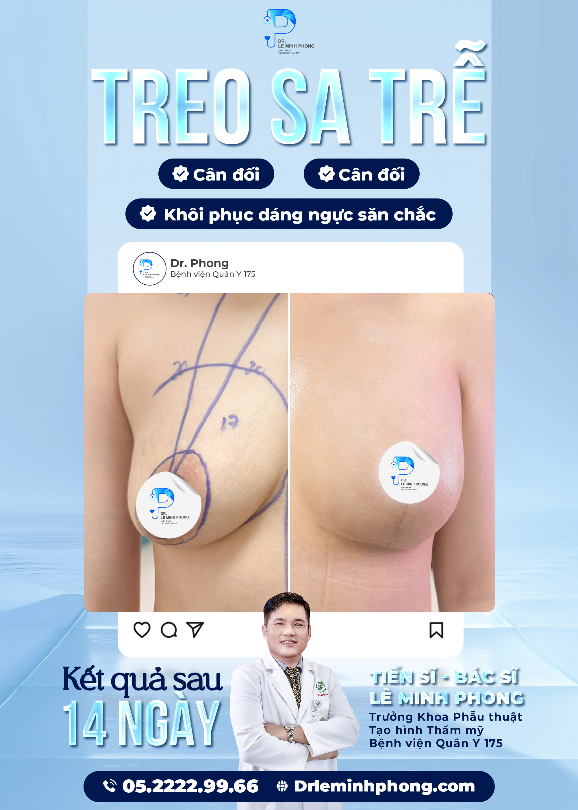 Treo sa trễ hồi phục sau 14 ngày 