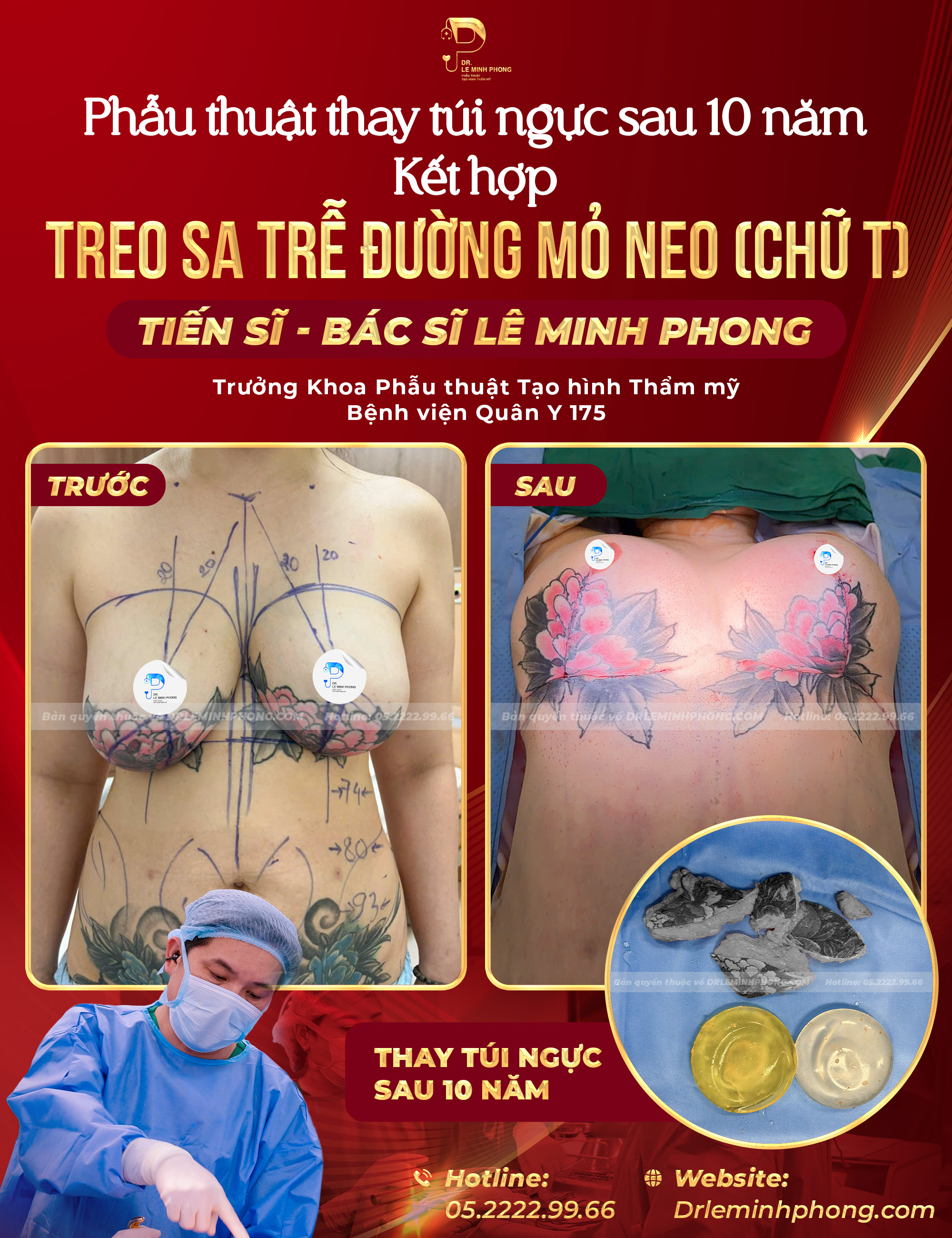 Phẫu Thuật Thay Túi Ngực Sau 10 Năm Kết Hợp Treo Sa Trễ Chữ T
