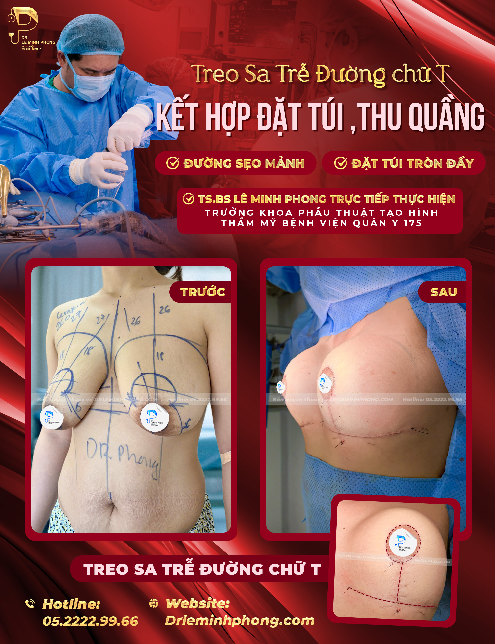 Treo sa trễ đường mỏ neo