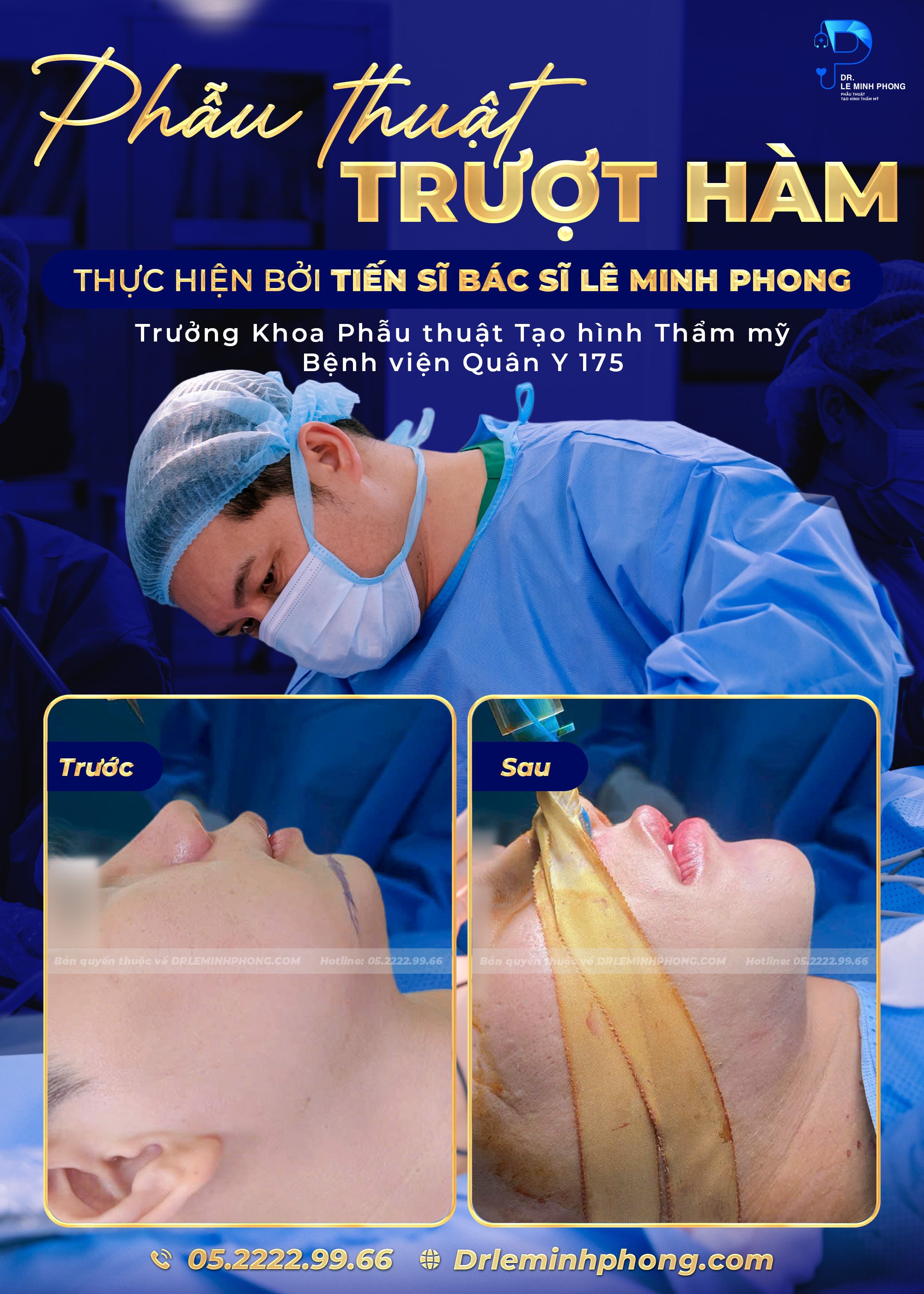 PHẪU THUẬT TRƯỢT CẰM THỰC HIỆN BỞI TS.BS LÊ MINH PHONG – HOÀN THIỆN TỶ LỆ GƯƠNG MẶT TỰ NHIÊN, HÀI HÒA