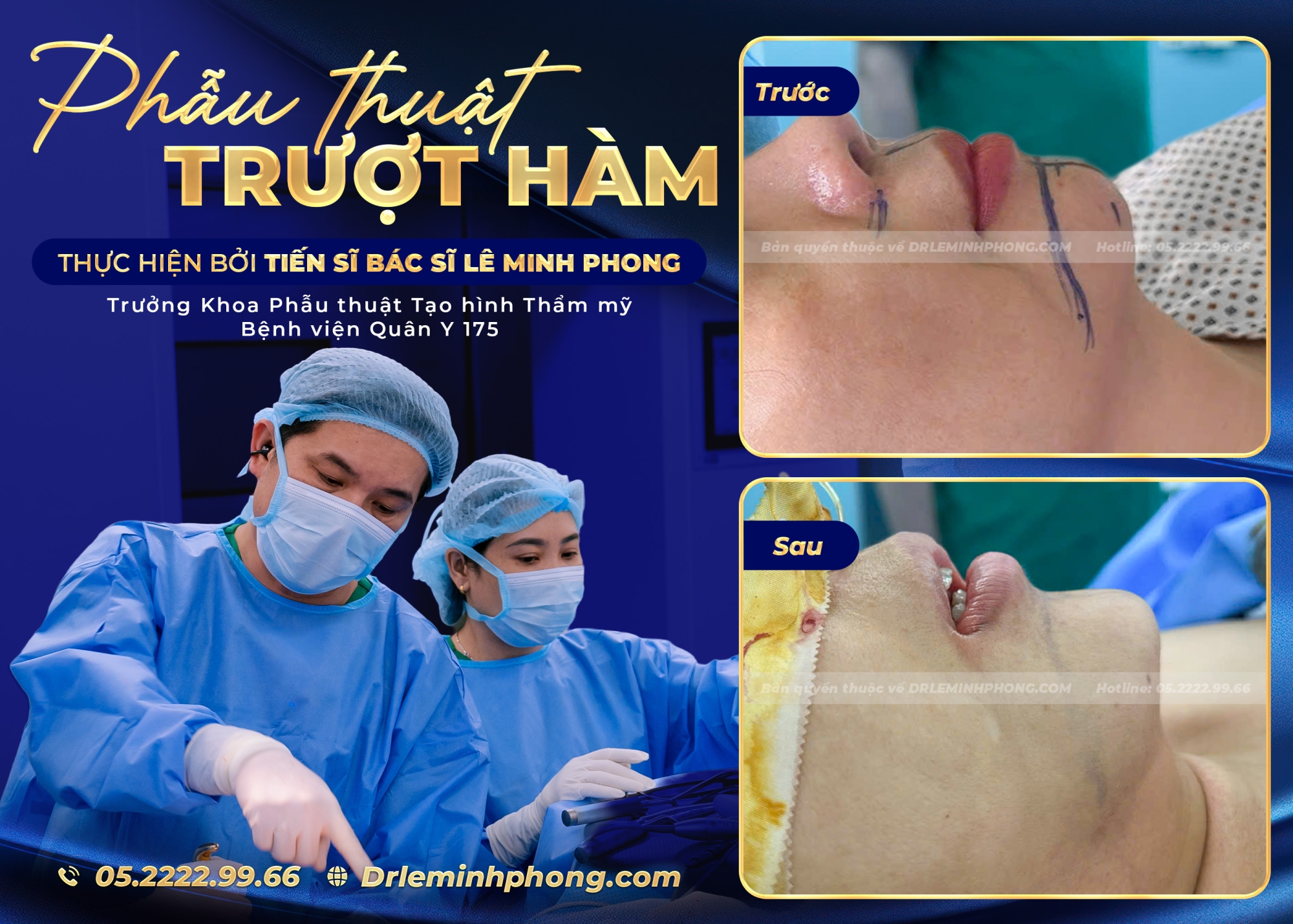 Phẫu Thuật Trượt Cằm – Hoàn Thiện Đường Nét Khuôn Mặt Tự Nhiên