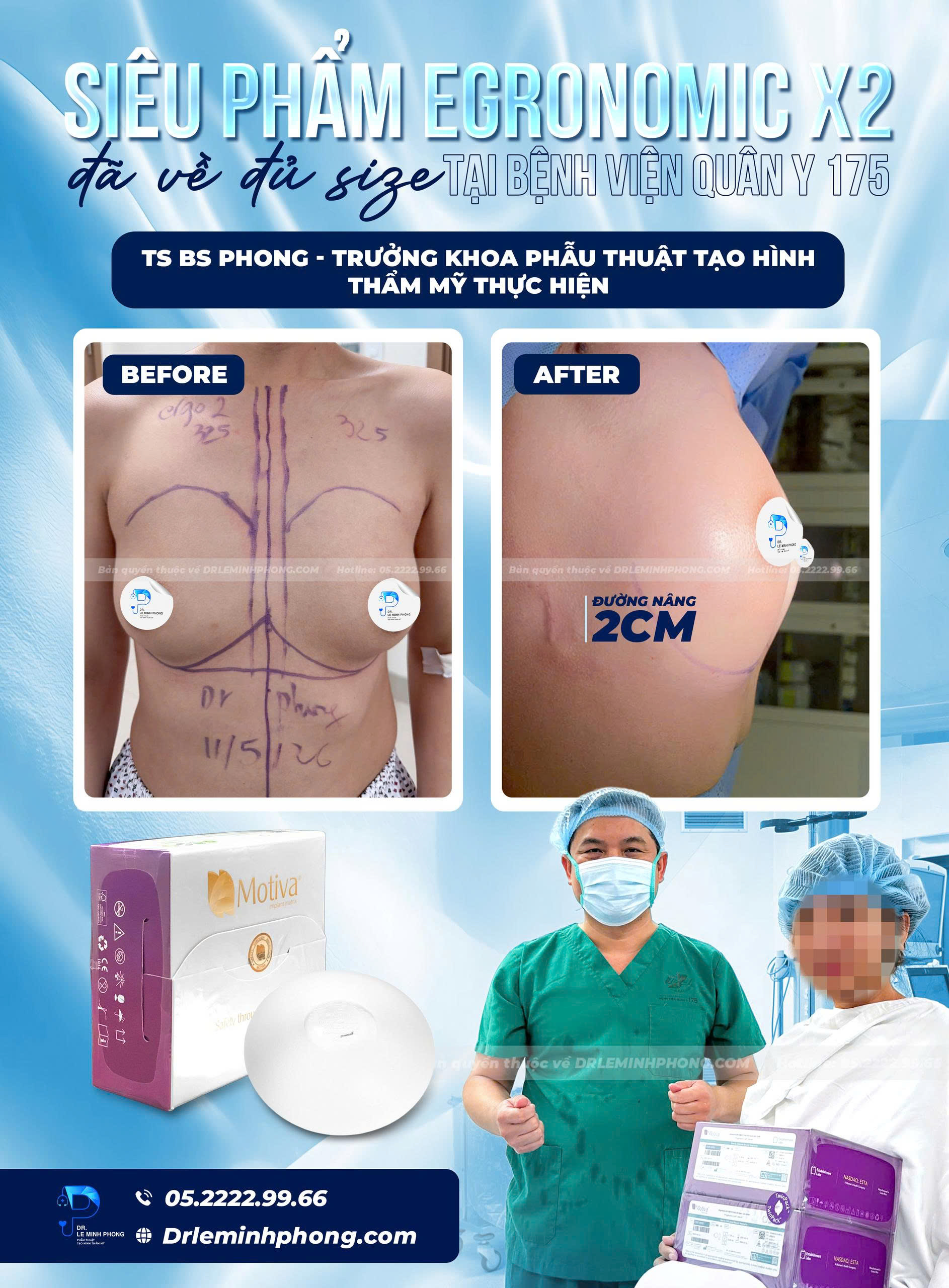 Túi Egronomic x2 325cc KH Ngực Nhỏ, đường nâng bên hông sườn ngực 2cm 