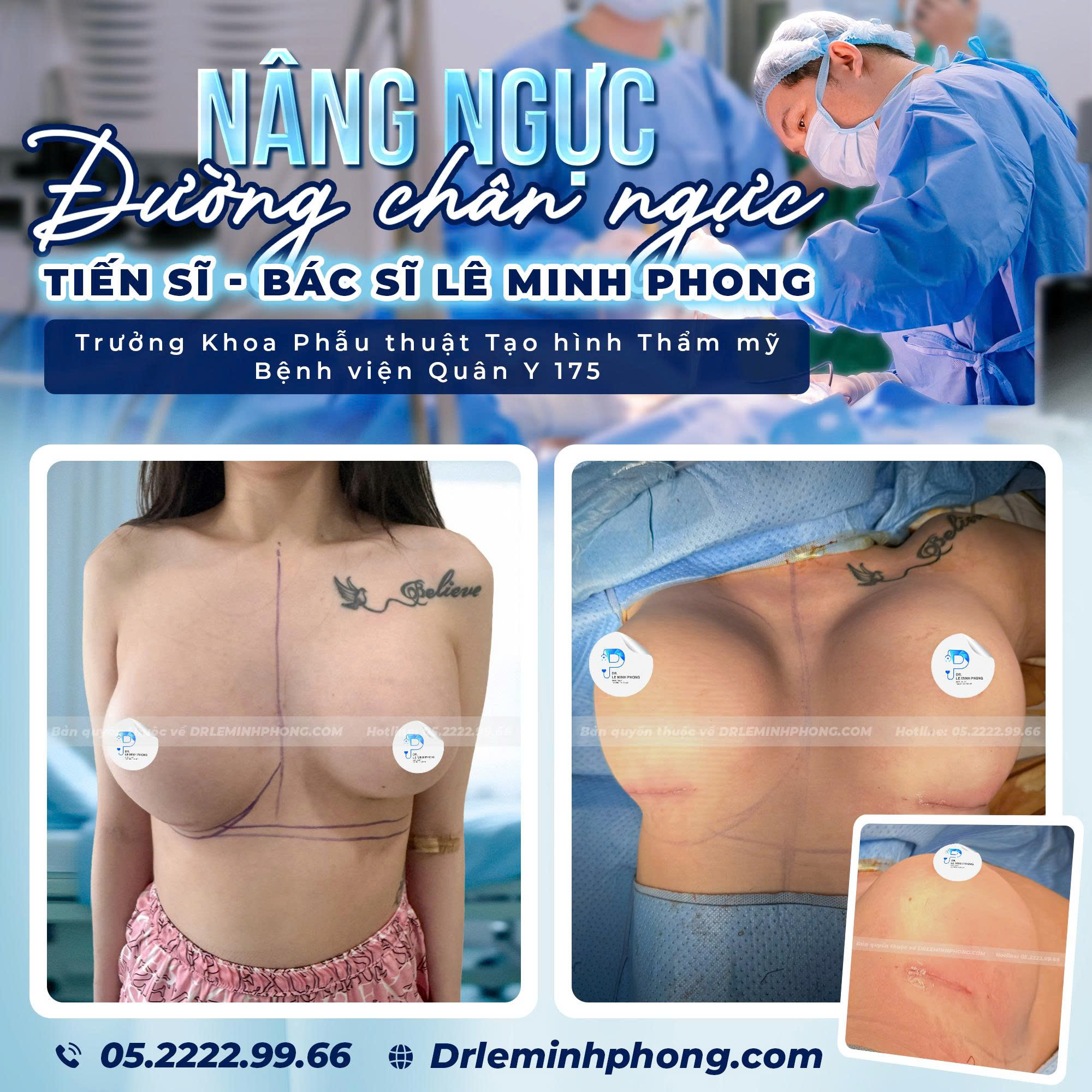 Sửa lại ngực đường chân ngực, ngực đã đặt túi không đều, ngực có mô tuyến