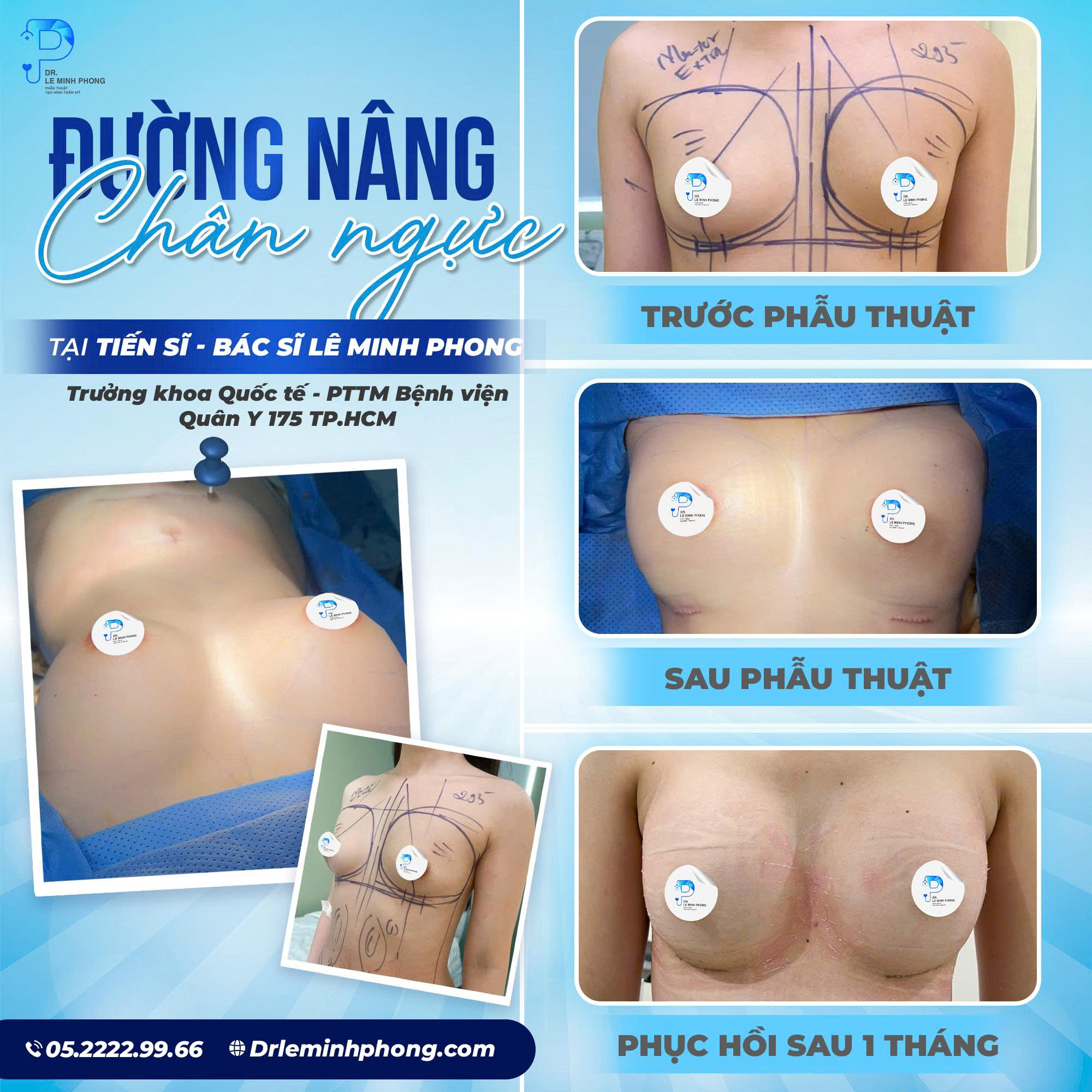 Túi mentor extra 295cc Ngực nhỏ - Đường chân ngực 