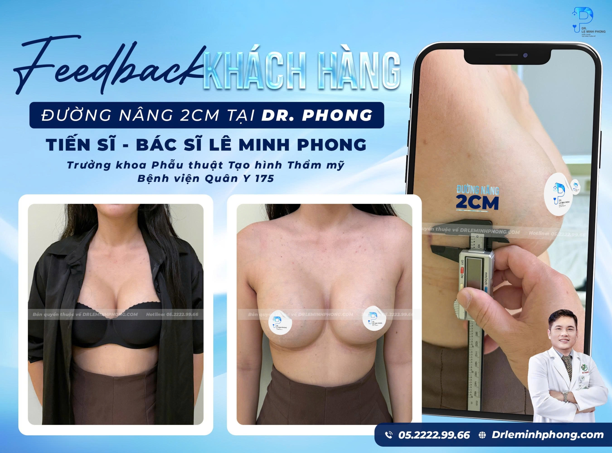 Feedback Khách Hàng Sau Nâng Ngực – Đường Nâng Chỉ 2cm