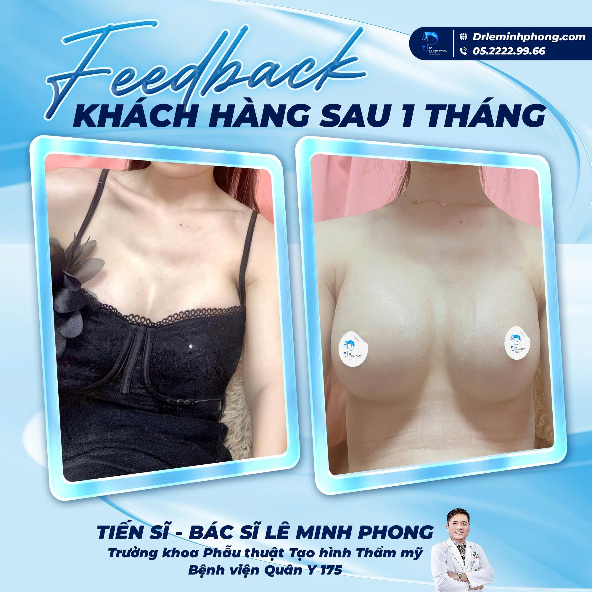 Feedback Khách Hàng Sau 1 Tháng Nâng Ngực – Đường Nâng Chỉ 2cm.