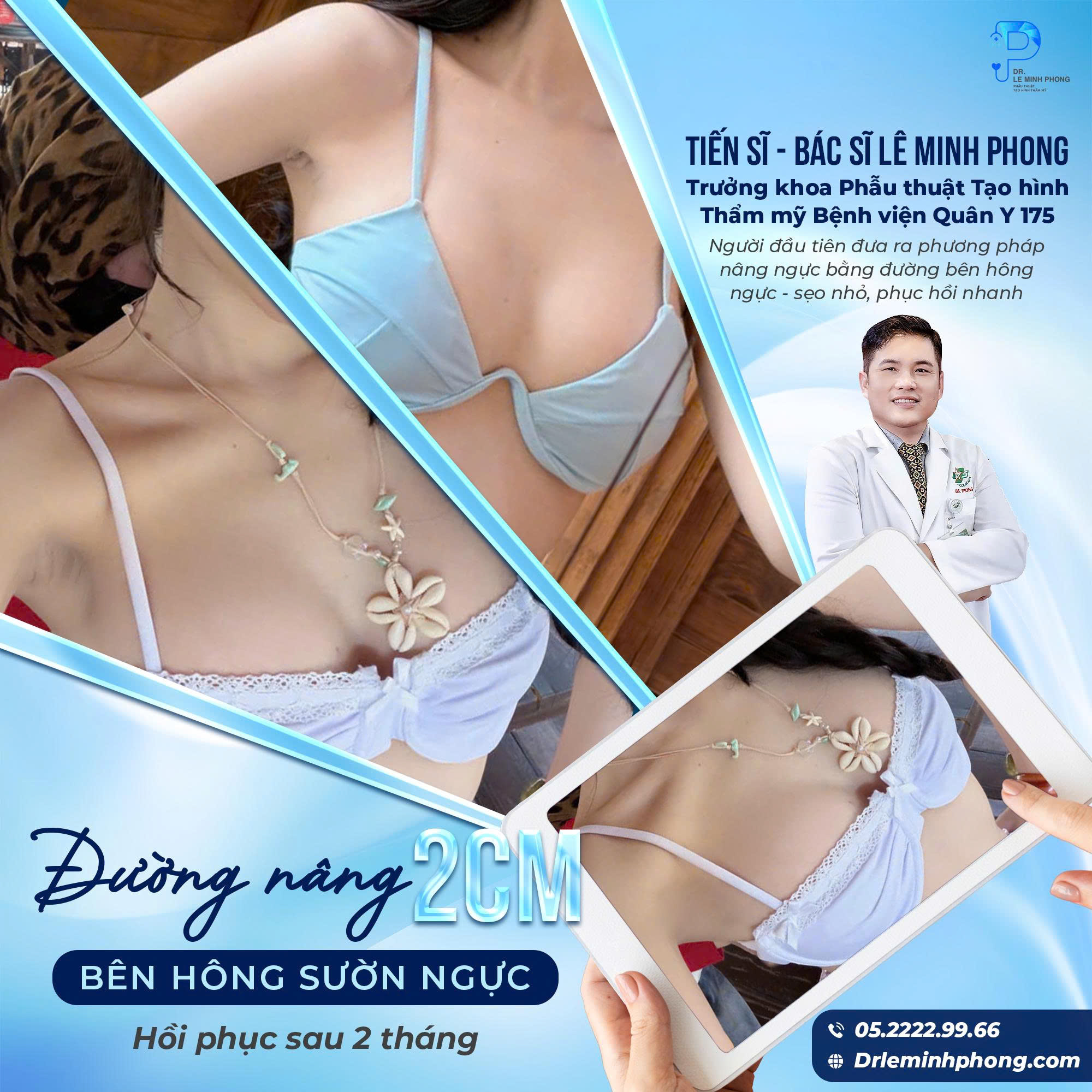 Feedback Khách Hàng Sau Nâng Ngực Đường 2cm – Tự Tin Diện Bikini Mùa Hè