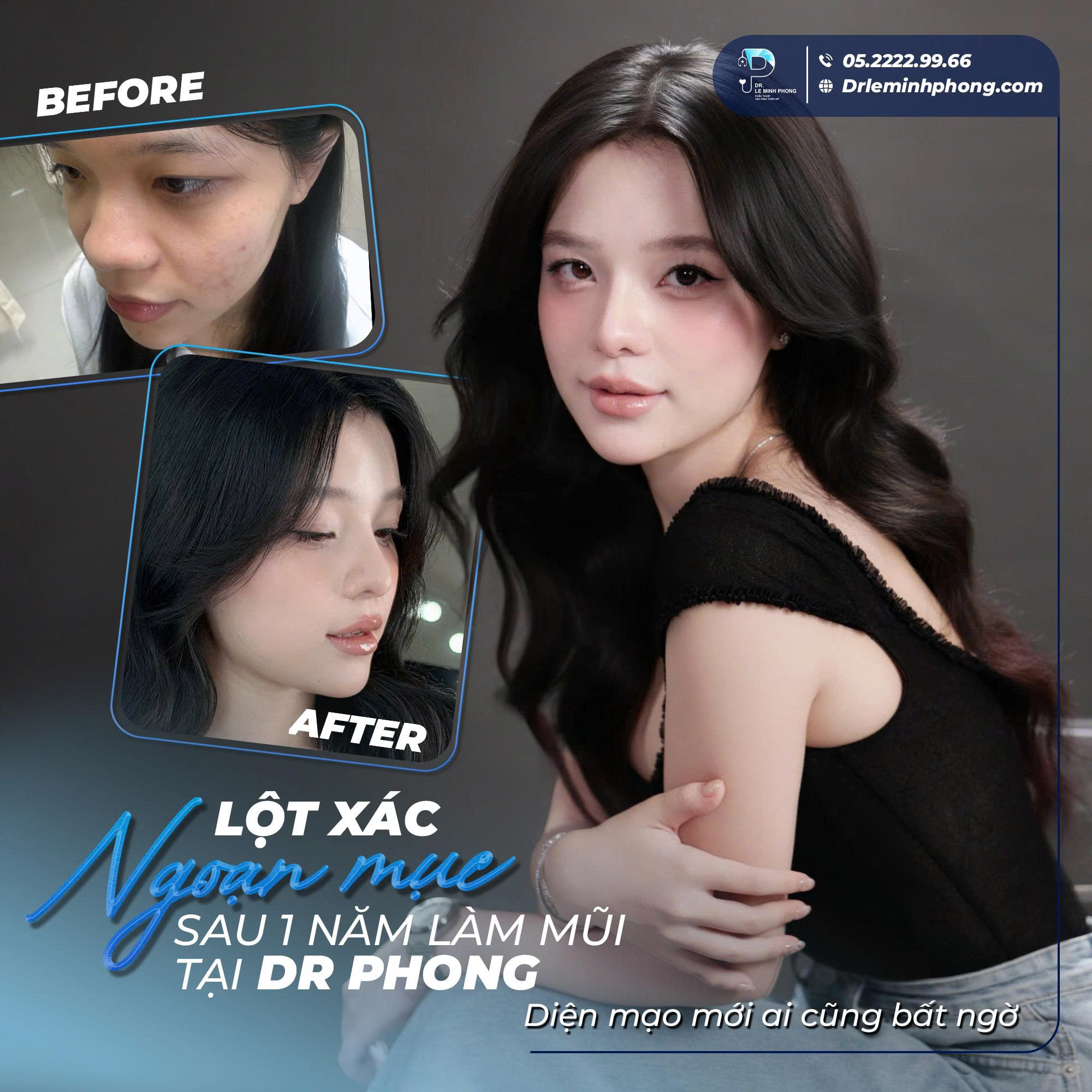 Feedback Thực Tế Sau 1 Năm Nâng Mũi – Đẹp Tự Nhiên Theo Thời Gian